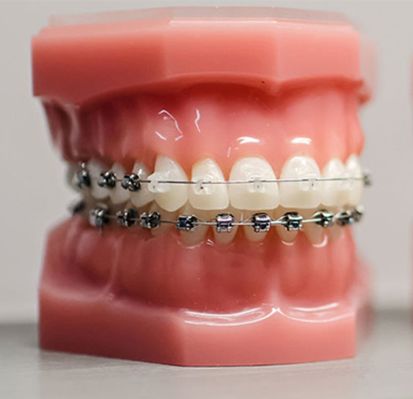 Брекеты — никогда не поздно