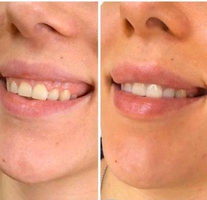 Коррекция десневой улыбки