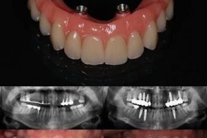 Имплантация — все на 4-х