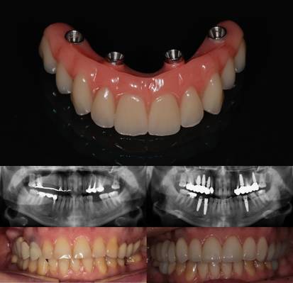 Имплантация — все на 4-х