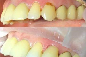 Прикорневой кариес