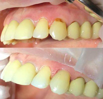 Прикорневой кариес