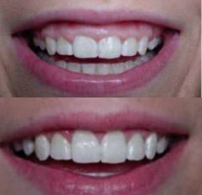 Коррекция десневого контура