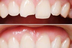 Реставрация передних зубов