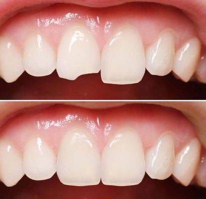 Реставрация передних зубов