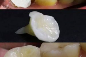 Керамическая вкладка