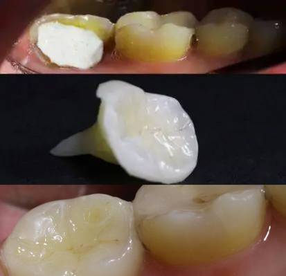 Керамическая вкладка