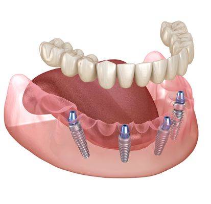 Восстановление всех зубов ALL-ON-4