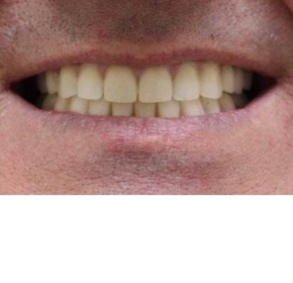 Зубы за 1 день в Краснодаре