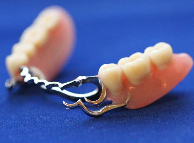 Бюгельные протезы