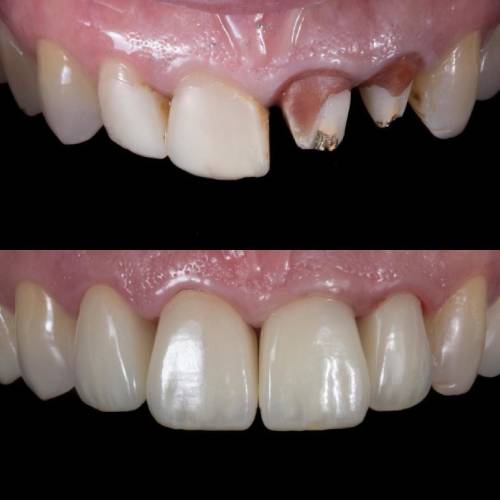 Циркониевые коронки