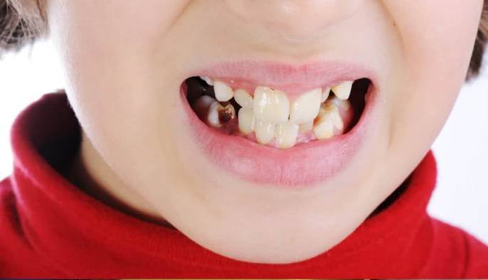 Кариес у детей