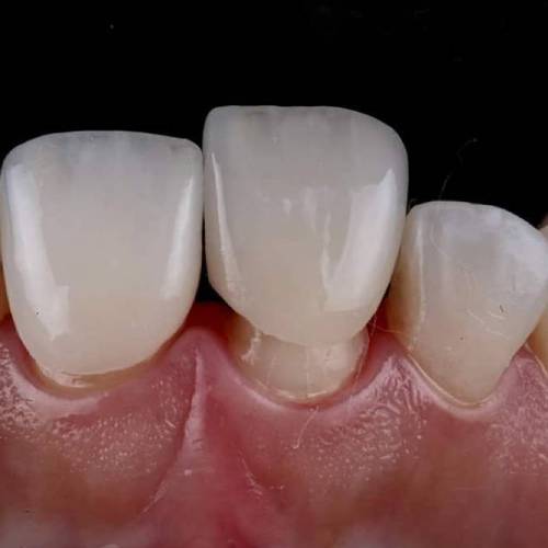 коронки из керамики