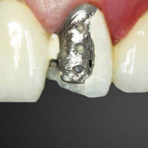 металлокерамика