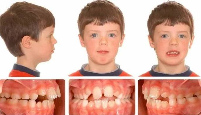 Неправильный прикус у детей