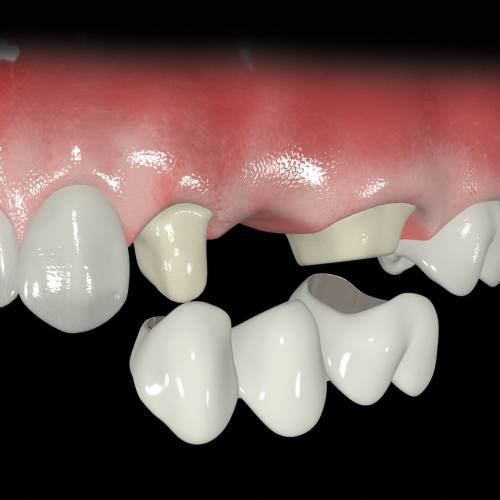 Несъемные зубные протезы