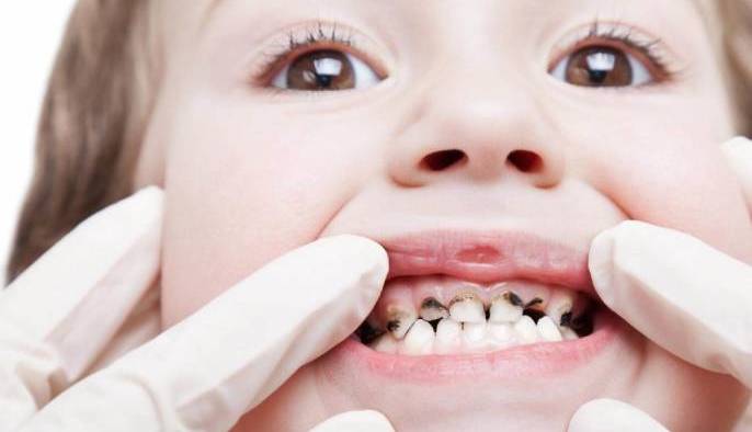 Пульпит у детей