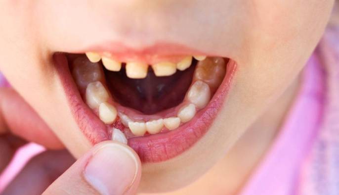 Удаление молочных зубов