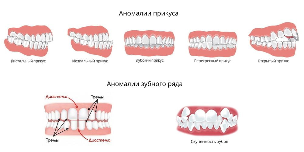 аномалии прикуса