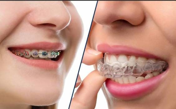 Брекеты или элайнеры