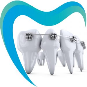 установка брекетов в краснодаре