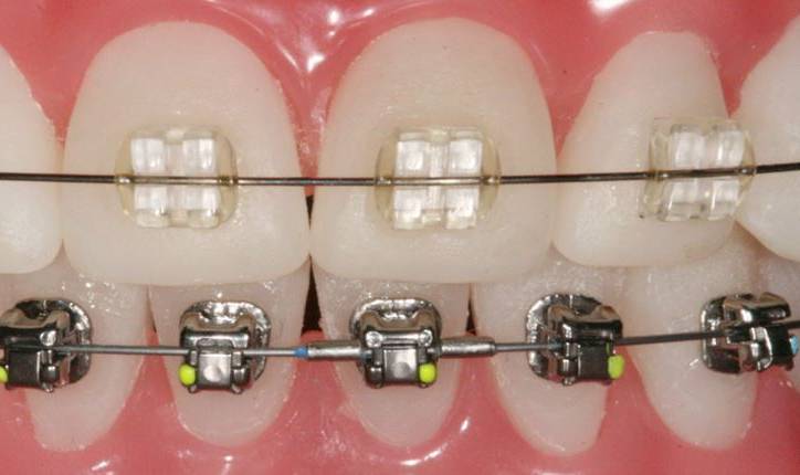 брекеты