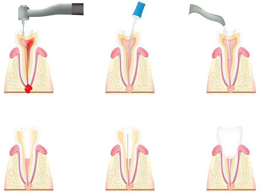 этапы лечения кариеса_
