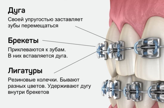 лигатурные брекеты