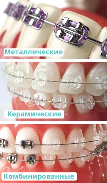 Типы брекетов по материалу изготовления