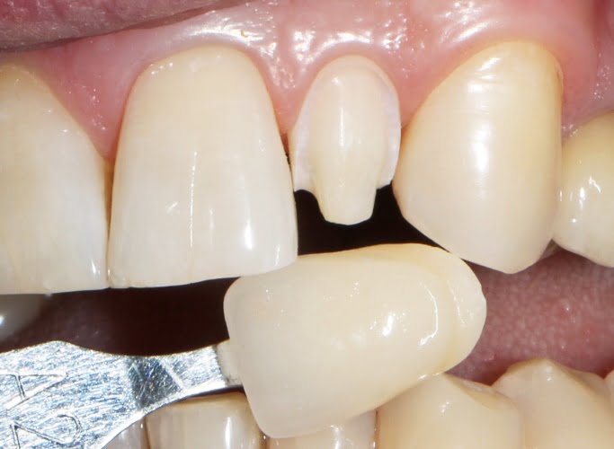 непрямой способ реставрации зубов