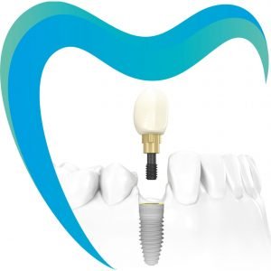 Все что нужно знать об одномоментной имплантации