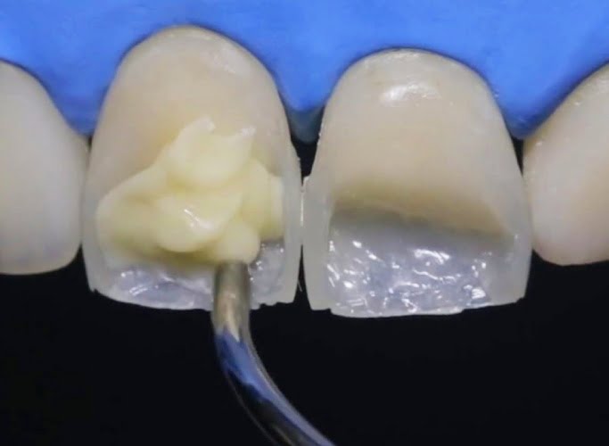 Прямая реставрация зубов