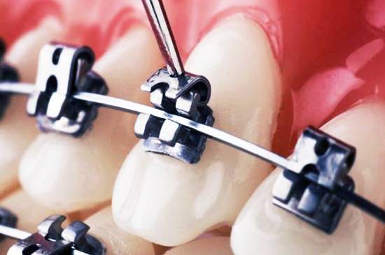 самолигирующие брекеты