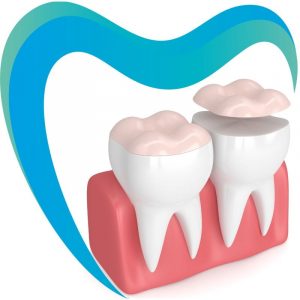 Установка виниров