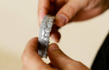 Установка брекетов