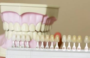 Установка виниров