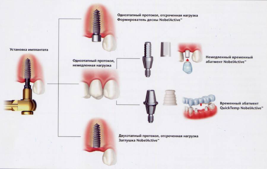виды одномоментной имплантации