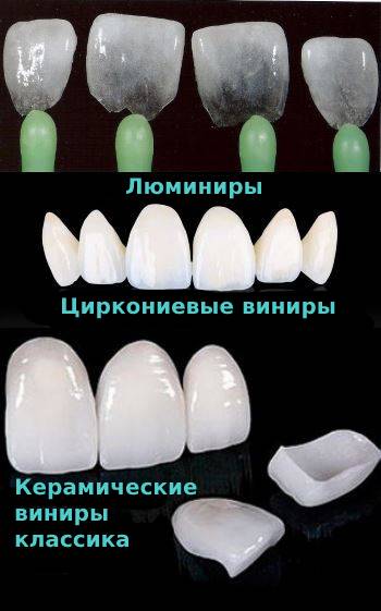 виды виниров