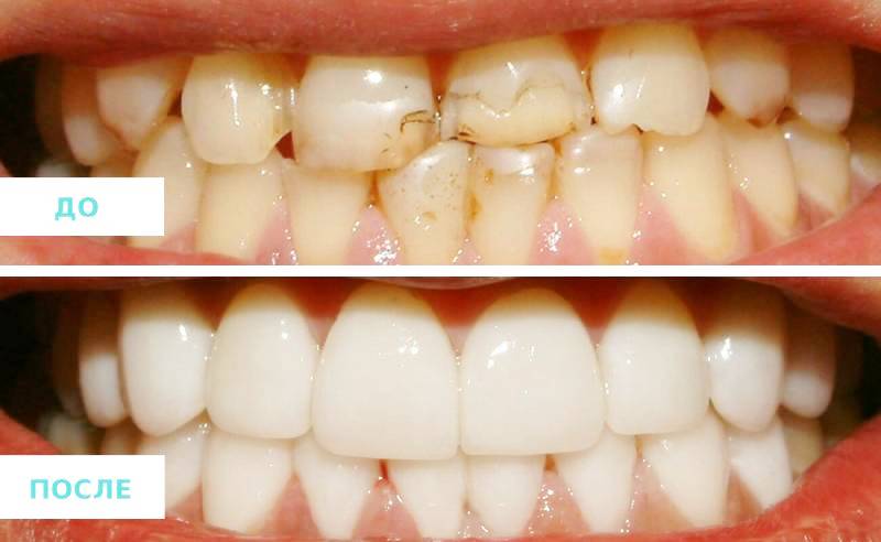 Виниры до и после