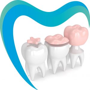 Керамические вкладки на боковые зубы