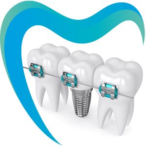 Брекеты или имплантация