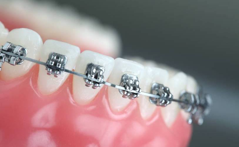 брекеты и импланты в стоматологии дава дентал