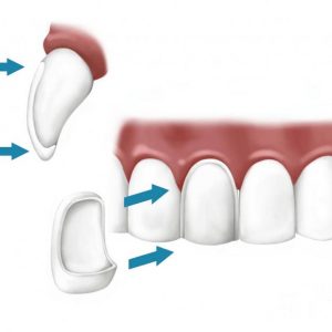 Виниры установка в Dava Dental Clinic