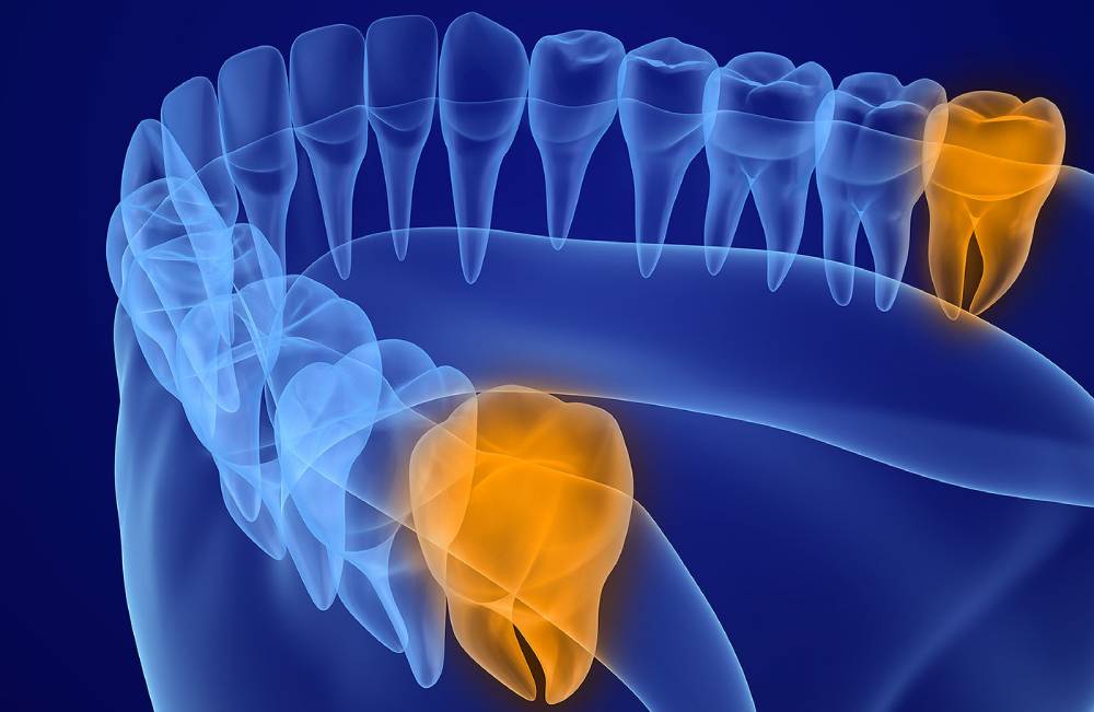 расположение зубов мудрости