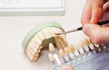 Виниры и люминиры в чем разница