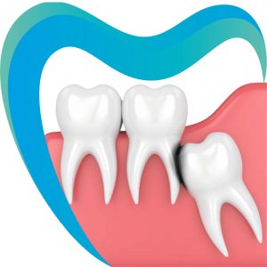 Зубы мудрости