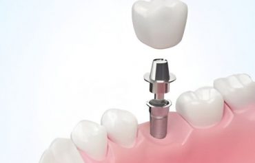 АLL-ON-4 имплантация