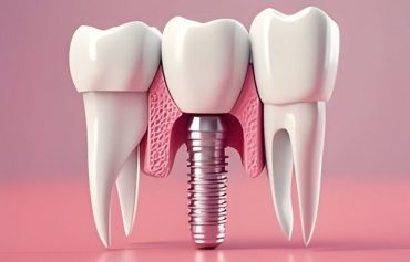 Аll-on-6 имплантация