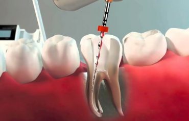 Лечение каналов зуба